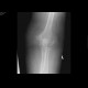 Pseudoarthrosis of humerus, supracondylic fracture: X-ray - Plain radiograph
